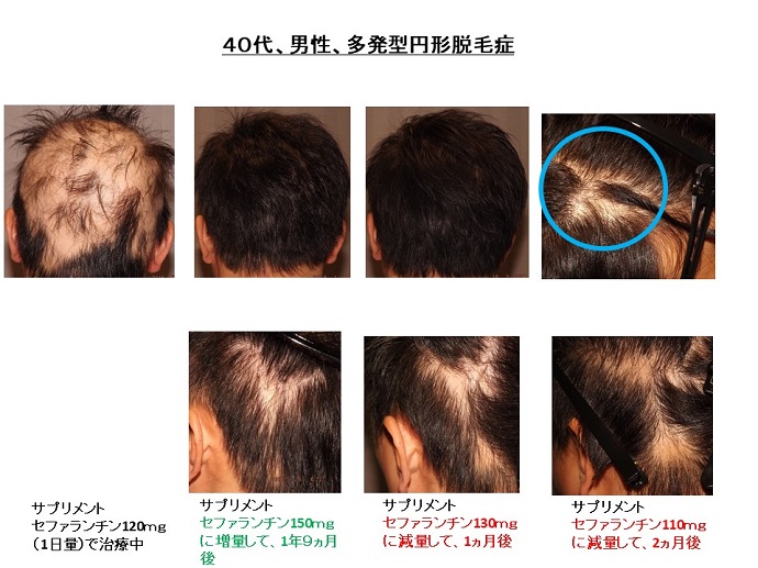 円形脱毛症　病院